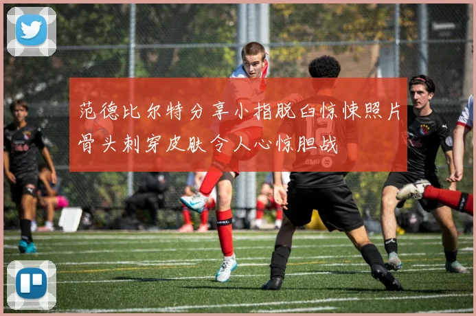 范德比尔特分享小指脱臼惊悚照片骨头刺穿皮肤令人心惊胆战